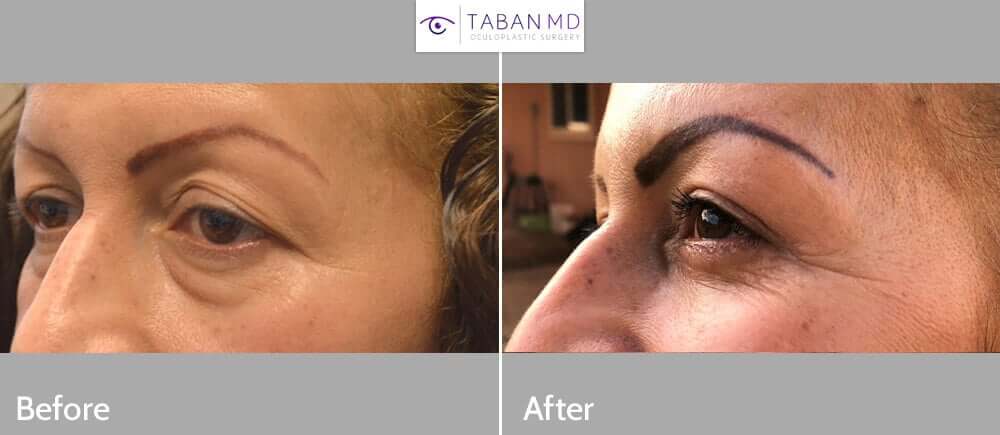 51 year old Hispanic female, complained of looking tired and older due to under eye fat bags with dark circles and loose upper lid skin. She underwent lower blepharoplasty (transconjunctival with fat repositioning, skin pinch) and upper blepharoplasty. Before and 2 months after cosmetic eyelid surgery photos are shown. (The after photo is selfie.)