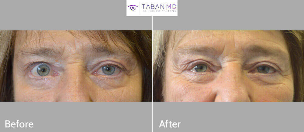 70 year old female, with upper eyelid asymmetry (uneven eyes) due to right upper eyelid retraction, underwent right upper eyelid retraction repair. Before and 3 months after eyelid surgery photos are shown. Note improve eye symmetry.