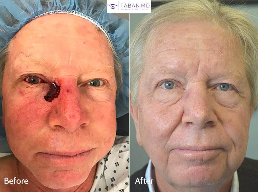 68 year old male, with large right eyelid and nose defect after Mohs surgery to remove basal cell carcinoma, underwent eyelid reconstruction. Before and 6 weeks after eyelid skin cancer reconstruction photos are shown.