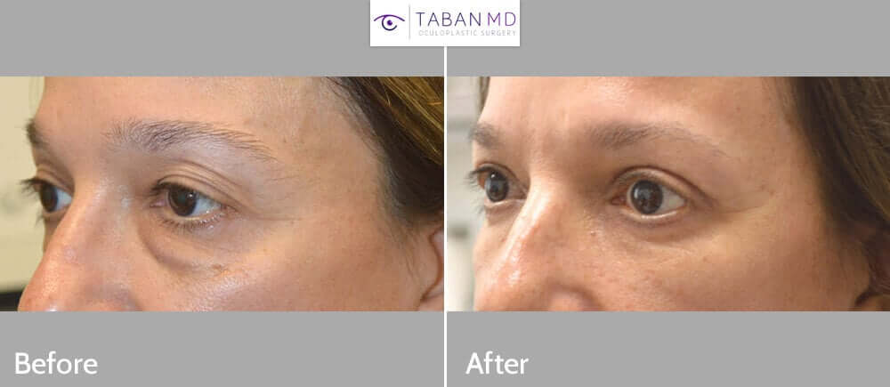 50+ year old female, looking tired and older due to under eye fat bags and dark circles and upper eyelid saggy loose skin, underwent quad-blepharoplasty: upper blepharoplasty (eyelid lift) and lower blepharoplasty (transconjunctival technique with fat bags redistribution and skin pinch). Before and 3 months after eye plastic photos are shown.