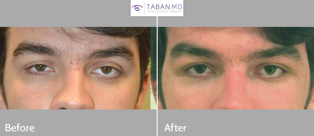 20 year old male, complained of uneven asymmetric eyes. This is due to sunken right eye from orbital blow out fracture and congenital left lower eyelid retraction. He already had right orbital fracture repair by another surgeon with persistent enophthalmos (sunken eye). He underwent left orbital decompression plus left lower eyelid retraction surgery. He also underwent droopy upper eyelid ptosis surgery on both eyes. Before and 6 weeks after eye plastic surgery photos are shown. Note improved eye symmetry and youthful eyes.