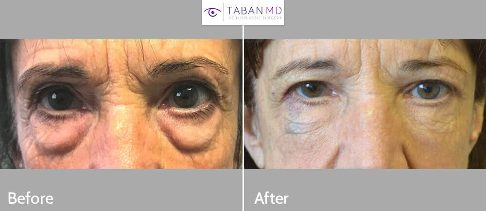 70 year old woman, looking tired and older due to under eye fat bags and dark circles, underwent transconjunctival lower blepharoplasty with fat bags repositioning and skin pinch followed later by cheek filler injection. Before and 3 months after cosmetic eyelid surgery photos are shown.