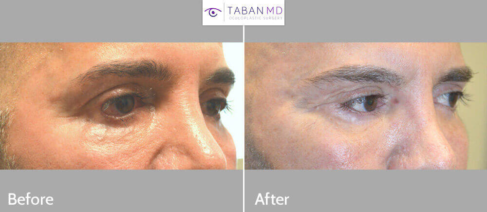 55 year old male, with severe lower eyelid retraction and eyelid scarring due to botched lower blepharoplasty with dry eyes due to inability to close eyes normally, underwent revision eyelid surgery to include lower eyelid retraction (internal approach, soof lift, alloderm spacer graft) with canthoplasty. Before and 3 months after corrective eyelid surgery photos are shown.