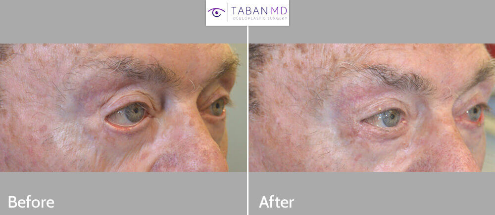 84 year old male, with severe right lower eyelid ectropion due to previous botched lower eyelid surgery and sun damage, underwent right lower eyelid ectropion repair with skin graft. Before and 3 months after reconstructive eye plastic surgery photos are shown.