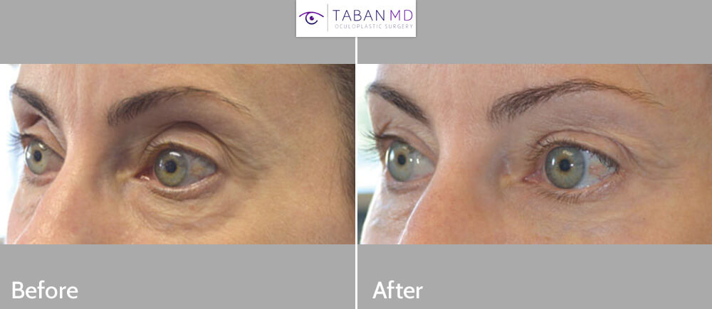 Middle age woman, who did NOT want surgery, complained of eyelid aging with hollowness around eyes giving sunken, aged eye appearance with dark circles and excess skin folds. She underwent NON-SURGICAL eyelid lift using eyelid FILLER injection to give more youthful results. Belotero was injected in upper eyelids and brows while Restylane was injected under eyes. Before and 1 month after eyelid filler injection photos are shown. She would benefit from conservative upper blepharoplasty to remove loose skin in the future.