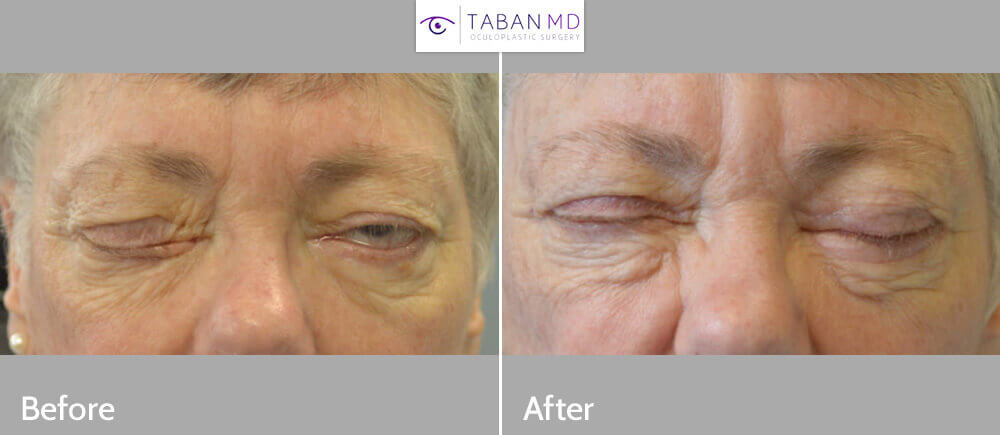 68 year old female, with paralytic left lagophthalmos (unable to close left eye) from left eyelid facial palsy, underwent left upper eyelid gold weight and left lower eyelid ectropion repair with skin graft. Before and 3 months after eyelid surgery photos are shown.