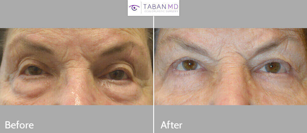 83 year old female, with upper eyelid ptosis with abnormal eyelid contour after failed upper eyelid ptosis surgery and blepharoplasty, underwent revision upper eyelid ptosis surgery using full-thickness method, where mainly the medial upper eyelids (segment closer to the nose) were lifted. She also had unrelated lower blepharoplasty (tranconjunctival with fat repositioning and skin pinch) for under eye bags. Before and 3 months after eyelid surgery photos are shown.