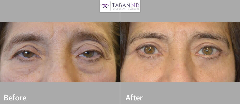 75 year old female, with tired older eye appearance with droopy upper eyelids and eye bags, underwent droopy upper eyelid (ptosis) repair and upper blepharoplasty and lower blepharoplasty (transconjunctival with fat repositioning and skin pinch excision). Before and 3 months after eyelid surgery photos are shown. Note improved rested eye appearance with natural results.