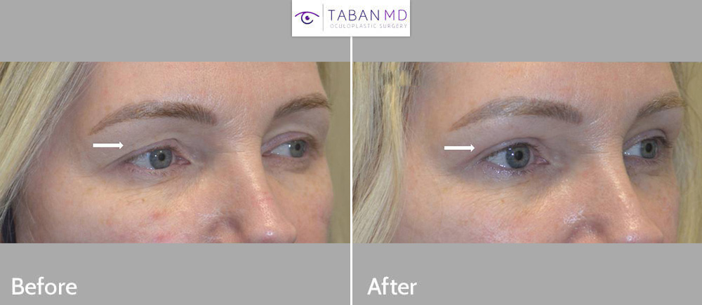 Beautiful woman underwent combined upper blepharoplasty (eyelid lift) and upper eyelid filler injection to create more youthful rested eyes.