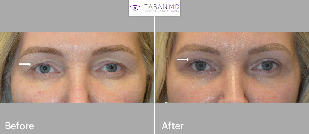 Beautiful woman underwent combined upper blepharoplasty (eyelid lift) and upper eyelid filler injection to create more youthful rested eyes.