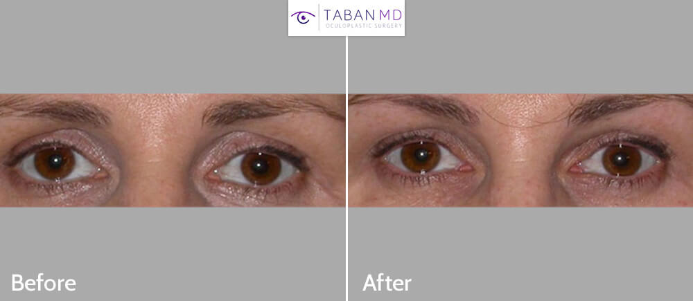 Before (left) and after (right) upper eyelid-brow filler injection to treat hollow upper eyelids, specially area closer to the nose.