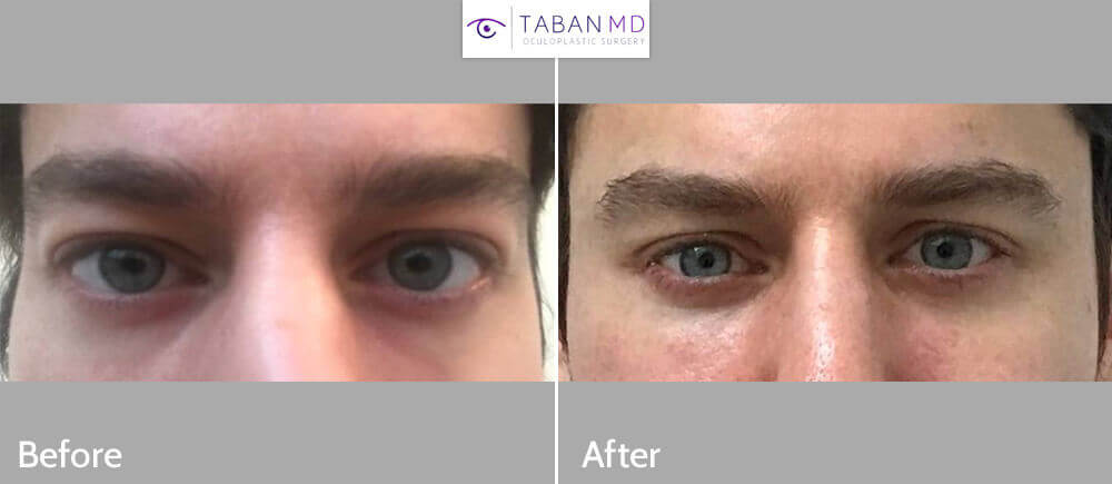 almond eye surgery Before and After Patient 28 Dr. Taban Beverly Hills