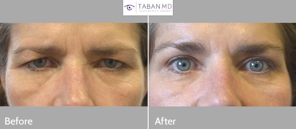 55 year old female, with droopy forehead/brows and excess upper eyelid skin, looking tired and angry, underwent endoscopic forehead lift and upper blepharoplasty. Before and 3 months after cosmetic surgery photos are shown.