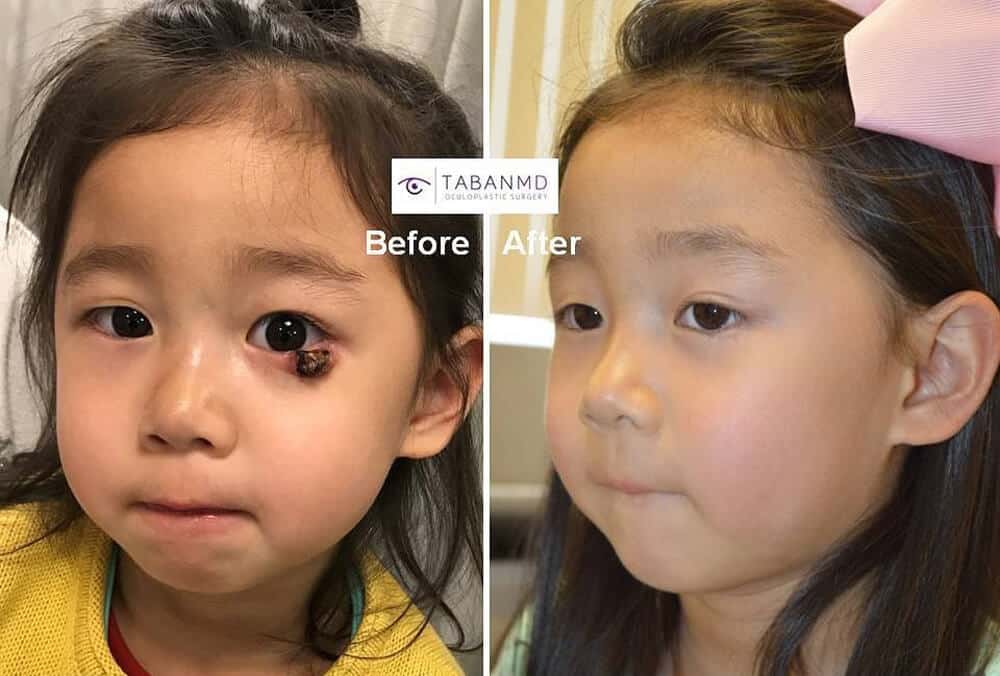 Beautiful brave young girl underwent successful complex eyelid reconstruction for a large necrotic eyelid lesion with skin graft.