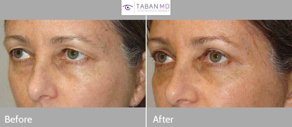 38 year old female, complained of saggy upper eyelids. She wanted to look better and less tired. She underwent cosmetic upper blepharoplasty (skin removal) and lateral brow lift (outer brow lifted using temple hairline incision), under local anesthesia in the office. Note natural, youthful results. Before and 3 months after cosmetic eyelid surgery photos are shown.
