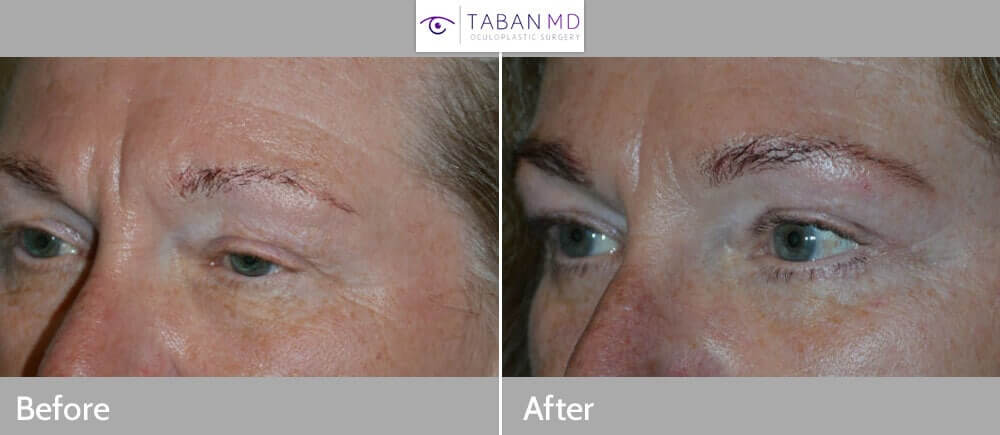 60+ year old female, complained of saggy droopy upper eyelids (secondary to eyelid ptosis and excess skin and lateral brow descent) and under eye wrinkles, underwent cosmetic eye plastic surgery including upper eyelid ptosis surgery (droopy eyelid surgery to raise the upper eyelids), upper blepharoplasty (to address the excess upper eyelid skin), and lower blepharoplasty (transconjunctival with fat repositioning and skin pinch). 3 months postoperative photos after eyelid surgery show the eyes are more open with rested, youthful, natural appearance.
