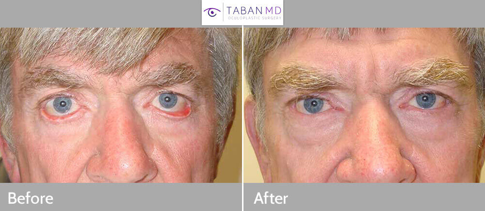 Middle age man, with severe bilateral lower eyelid cicatricial ectropion (eyelid rolls away from the eyeball, secondary to tight skin from chronic sun damage) with eye redness, underwent reconstructive eyelid surgery, namely lower eyelid ectropion surgery with skin graft where skin was taken from the upper eyelid and brought to the lower eyelid. Before and 4 months postoperative photos are shown.