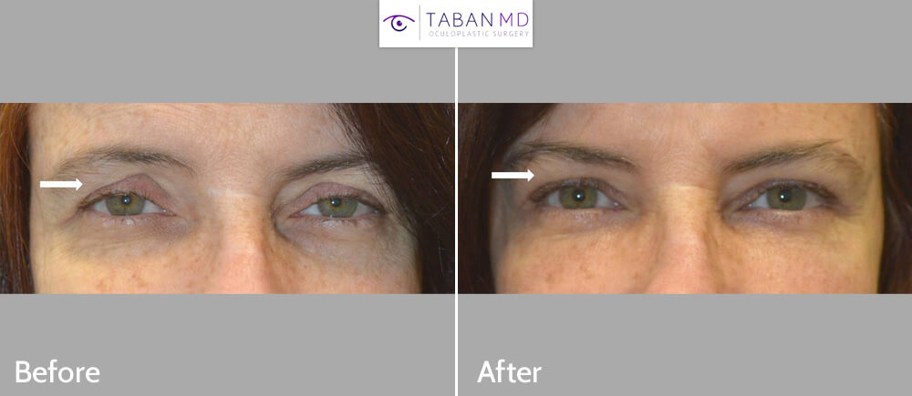 Middle age woman, looking tired, underwent upper blepharoplasty, droopy upper eyelid ptosis surgery, and upper eyelid filler injection. Before and 1 month after eyelid surgery photos are shown. Note more youthful eye appearance.