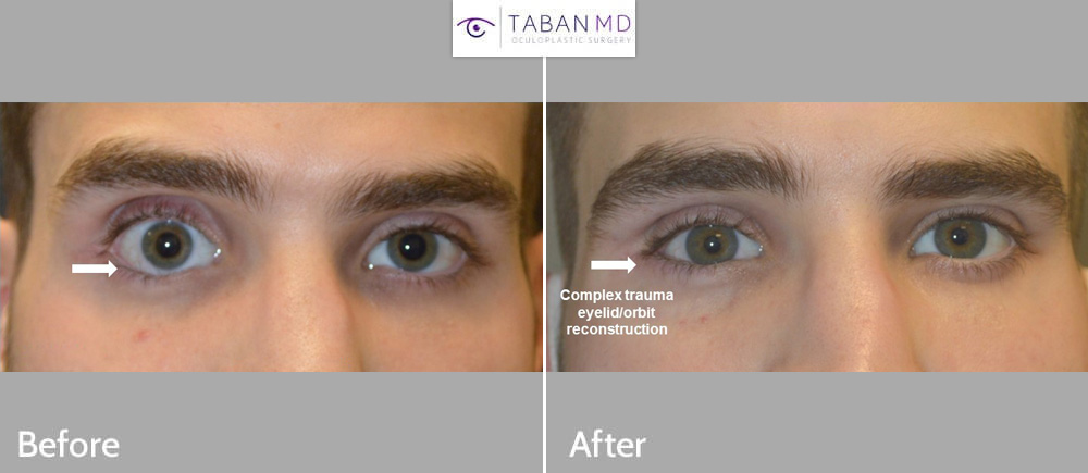 Young man, with severe major right eye trauma, resulting in significant sunken eye and eyelid retraction, who had undergone one previous unsuccessful orbital fracture repair (by another surgeon), underwent revision right orbital implant (removal of old and placement of new implant) plus lower eyelid retraction repair plus upper eyelid filler injection. Note more balanced eye appearance.