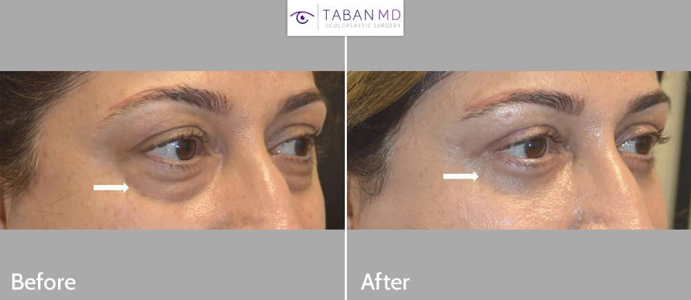Middle age woman underwent lower blepharoplasty (transconjunctival technique with fat repositioning plus skin pinch excision) to improve both under eye fat bags and tear trough hollowness under eyes.