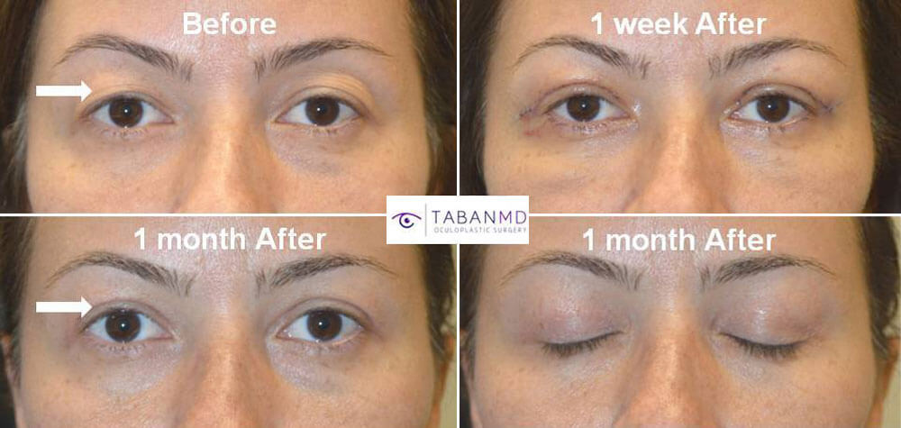 Young woman, with hooded saggy loose upper eyelid skin underwent upper blepharoplasty. Before, 1 week after, and 1 month after surgery results are shown.