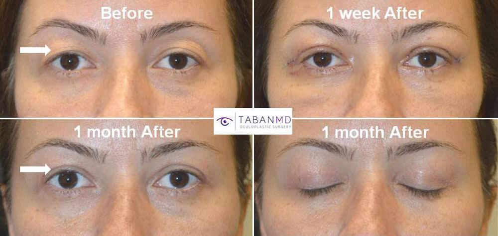 Upper Blepharoplasty Before And After Photos Infoupdate