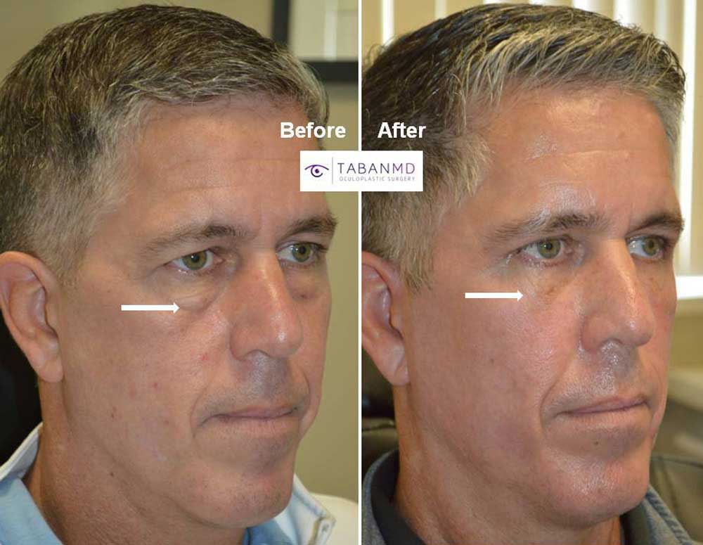 51 year old male underwent lower blepharoplasty (transconjunctival with fat repositioning, skin pinch) and conservative upper blepharoplasty and later conservative upper cheek filler injection. Note more rested youthful eye appearance with natural results.