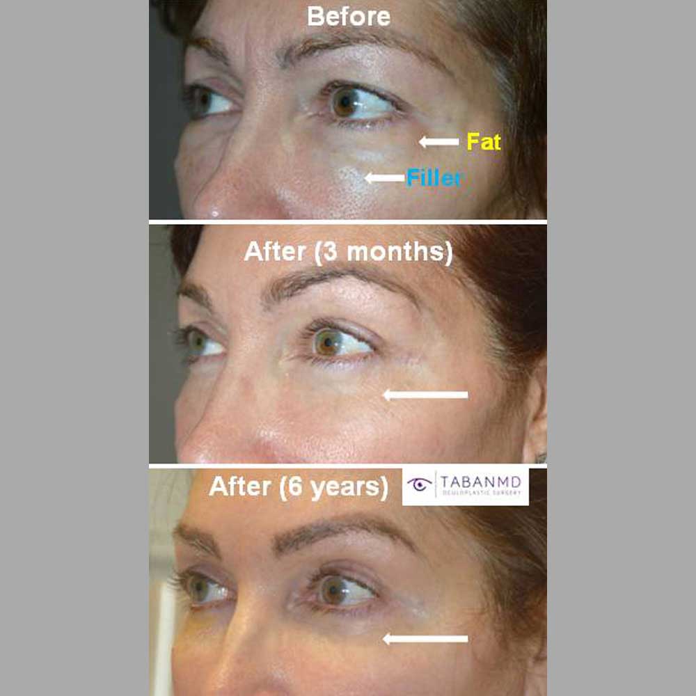 50 year old woman, with history of under eye filler, underwent lower blepharoplasty (after dissolving the filler with hyaluronidase). Note long-term results with natural youthful eye appearance.