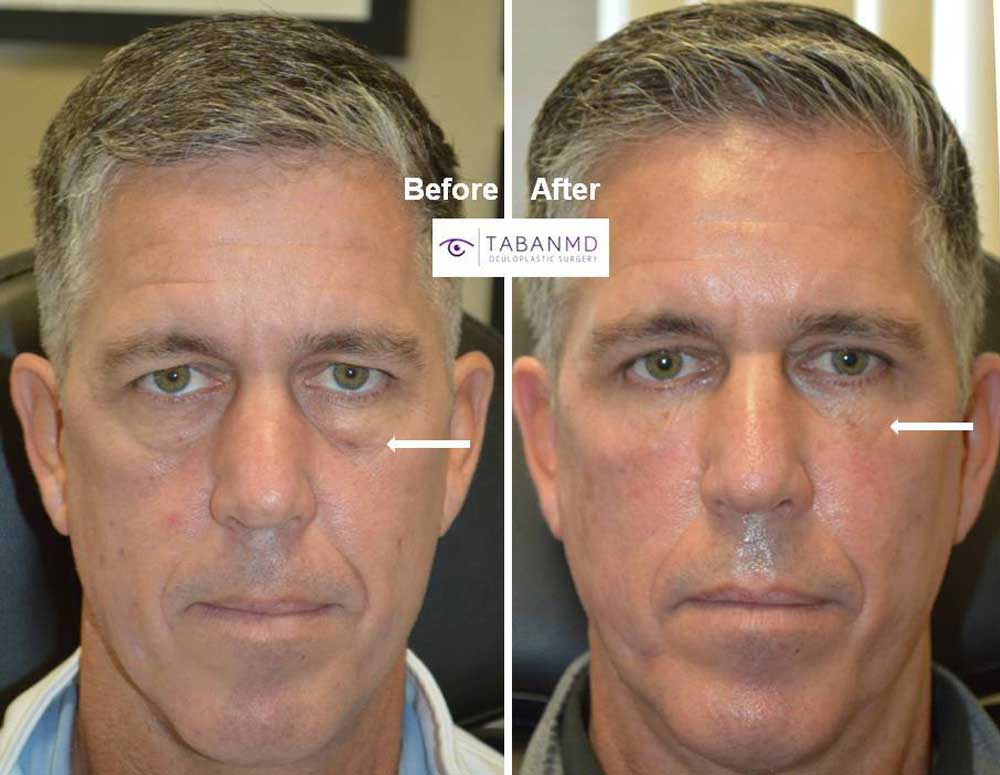 51 year old male underwent lower blepharoplasty (transconjunctival with fat repositioning, skin pinch) and conservative upper blepharoplasty and later conservative upper cheek filler injection. Note more rested youthful eye appearance with natural results.
