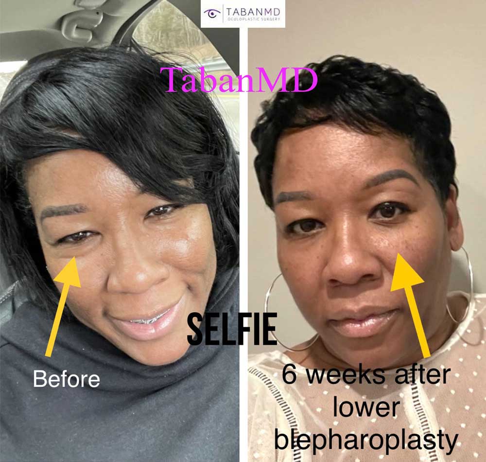 Middle age African American woman underwent scarless lower blepharoplasty to correct under eye fat bags. Note more youthful appearance in her after selfie photo.