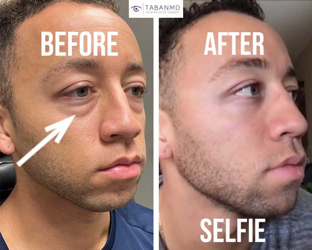 Young man, with genetic under eye fat bags, underwent scarless lower blepharoplasty. Note more youthful eye appearance in his after selfie photo. Note change from double roll to single roll under eyes.