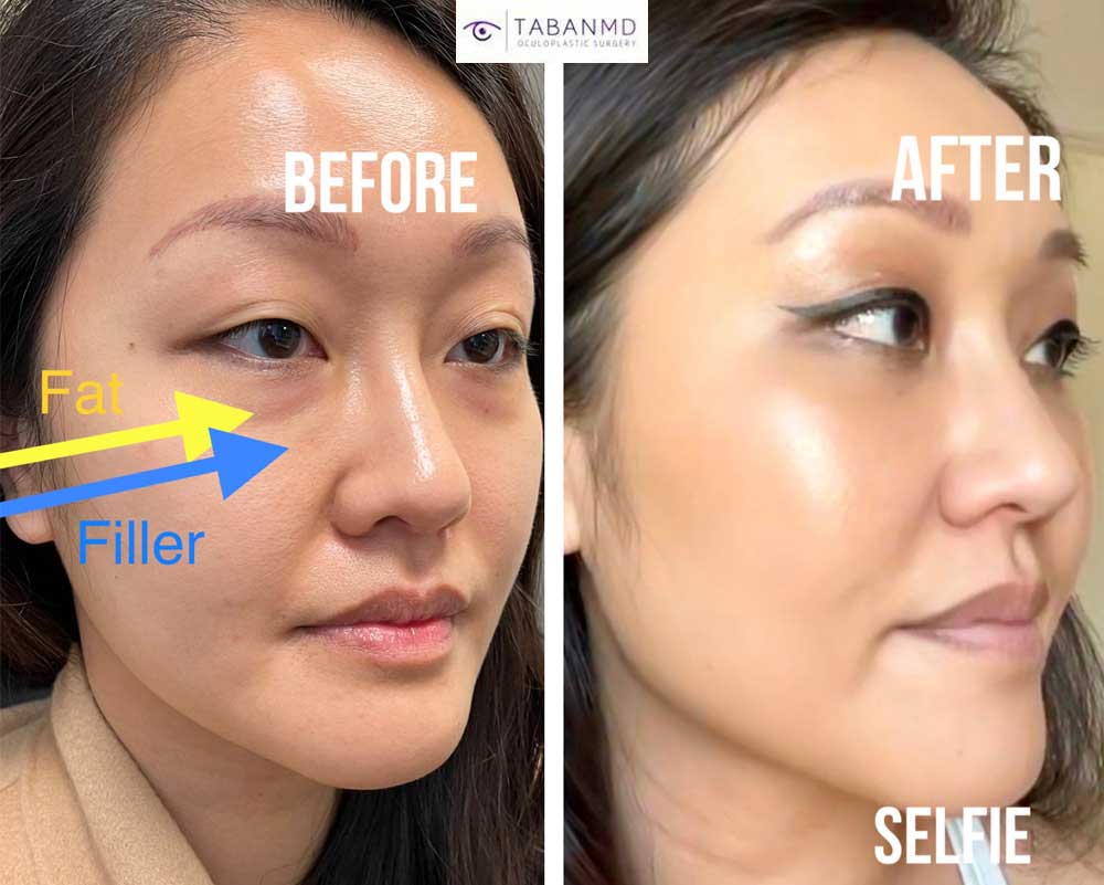 Young Asian woman, underwent scarless lower blepharoplasty for under eye fat bags after hyaluronidase to dissolve tear trough filler placed by another injector.