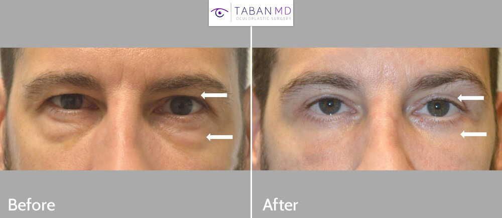 45 year old man, looking tired and older, underwent male upper blepharoplasty and lower blepharoplasty (transconjunctival technique with eye fat bags repositioning, skin pinch), to look more refreshed with natural results.