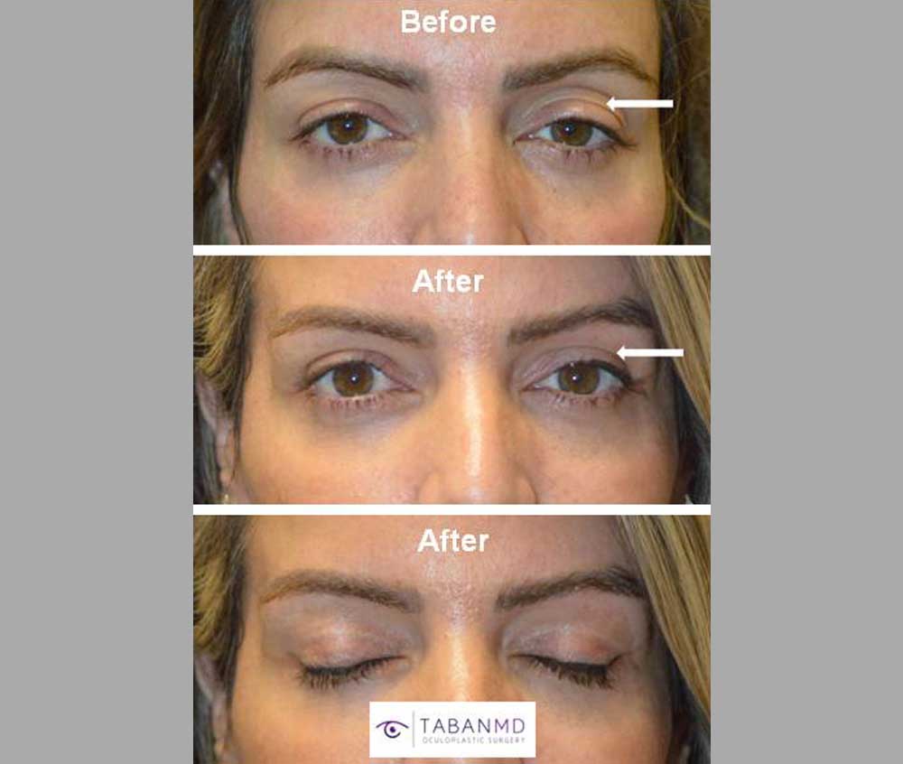 41 year old female, with tired eye appearance and eye asymmetry, underwent droopy upper eyelid ptosis surgery, upper blepharoplasty, and upper lid filler injection. Note more youthful eye appearance.