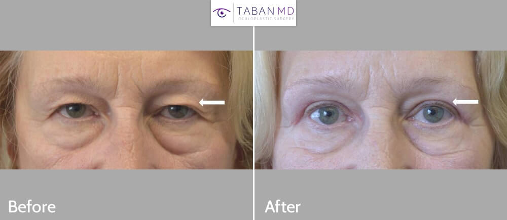 66 year old female with significant loose upper eyelid skin underwent upper blepharoplasty. Note more rested eye appearance after eyelid lift.