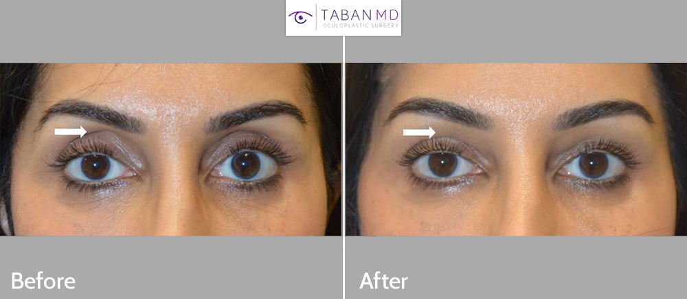 Young woman underwent upper eyelid filler injection to improve sunken hollow upper eyelids.