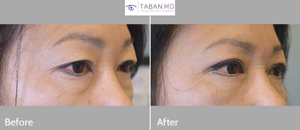 Middle age Asian female, underwent Asian upper blepharoplasty with crease formation. Before and 2 months after Asian blepharoplasty photos are shown.