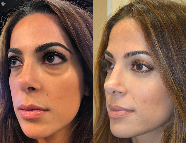 Taban Beforeandafter 1a Taban Md Oculoplastic Cosmetic Eyelid Plastic Surgeon Beverly Hills Los 