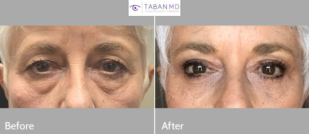 72 year old female, complained of looking older and tired with saggy droopy upper eyelids and eye bags. She underwent upper blepharoplasty, droopy upper eyelid ptosis surgery, transconjunctival lower blepharoplasty with fat repositioning with skin pinch and lateral pretrichial brow lift. Before and 3 months after eye plastic surgery photos are shown. (After photo is a selfie.)