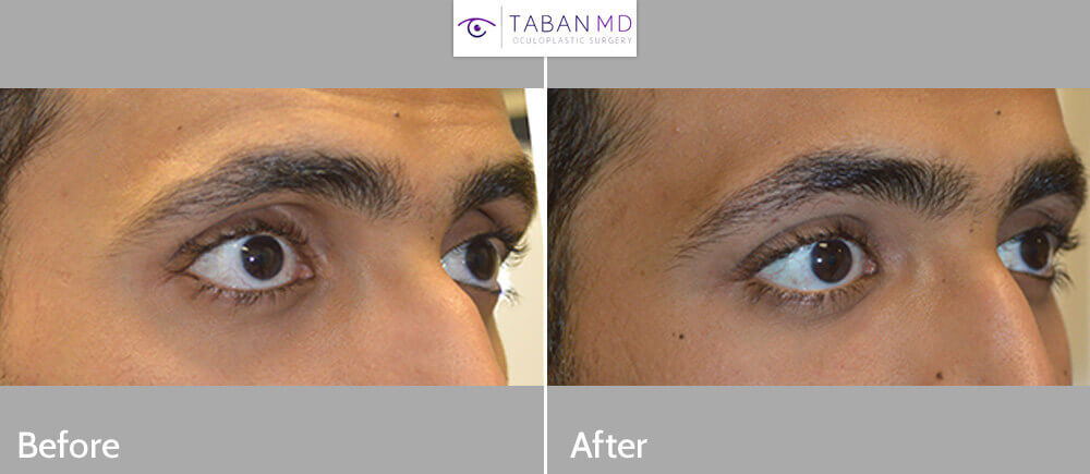 Young man, from Saudi Arabia, complained of sunken hollow eyes and dark circles. He underwent upper eyelid filler and under eye filler injection. Before and immediately after eyelid filler injection photos are shown.