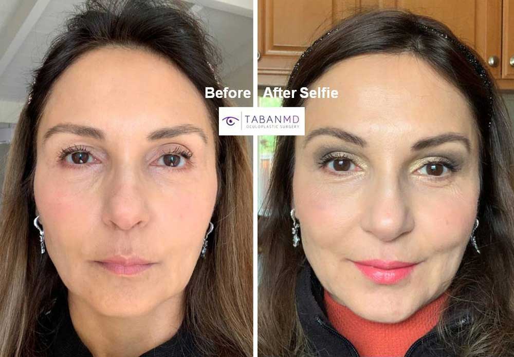 Selfie photos of woman who underwent combined upper blepharoplasty (eyelid lift) and upper eyelid filler injection to address upper eyelid aging (loose saggy skin and hollowness due to fat loss). Note more youthful eye appearance.