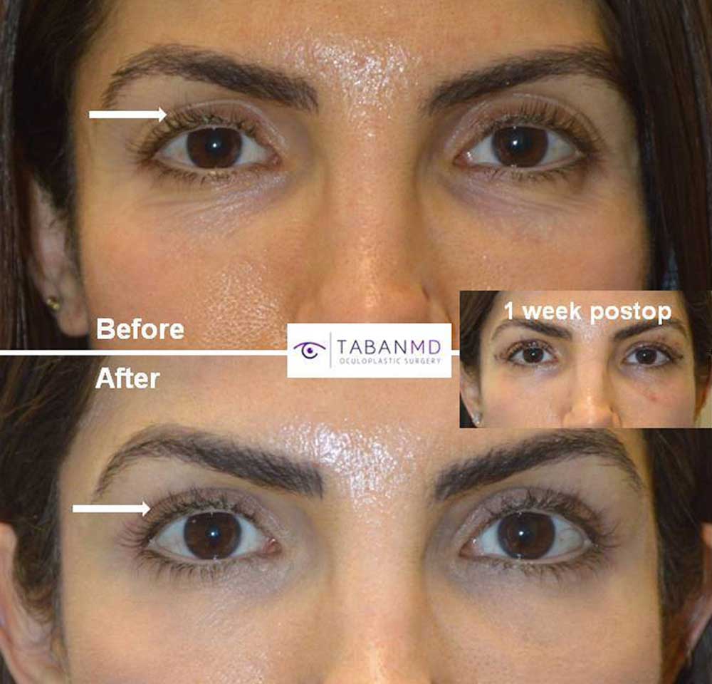 Young woman, with sunken upper eyelids and loose skin folds and eye asymmetry, underwent combined upper blepharoplasty (eyelid lift) and upper eyelid filler injection.