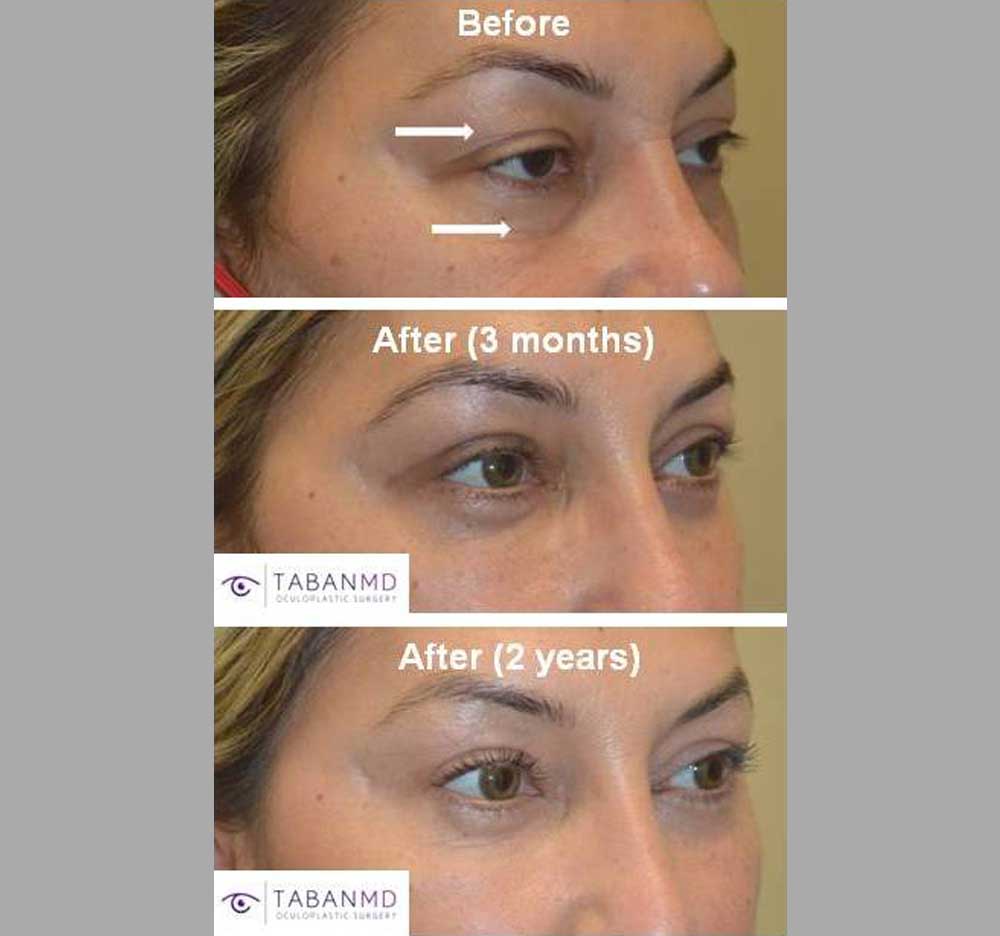 45 year old female, with eyelid aging, saggy droopy upper eyelids, and under eye bags and wrinkles, underwent upper blepharoplasty (eyelid lift), droopy eyelid ptosis surgery, and lower blepharoplasty. Note more youthful natural appearance with long lasting results.