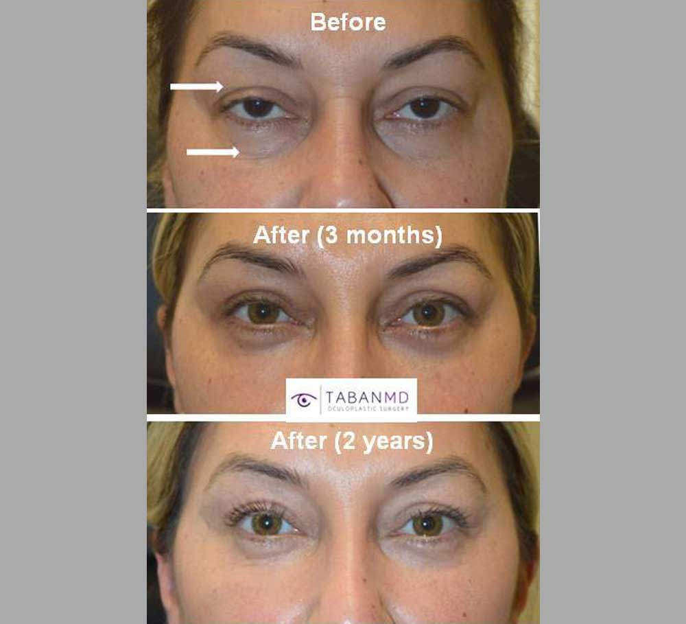 45 year old female, with eyelid aging, saggy droopy upper eyelids, and under eye bags and wrinkles, underwent upper blepharoplasty (eyelid lift), droopy eyelid ptosis surgery, and lower blepharoplasty. Note more youthful natural appearance with long lasting results.