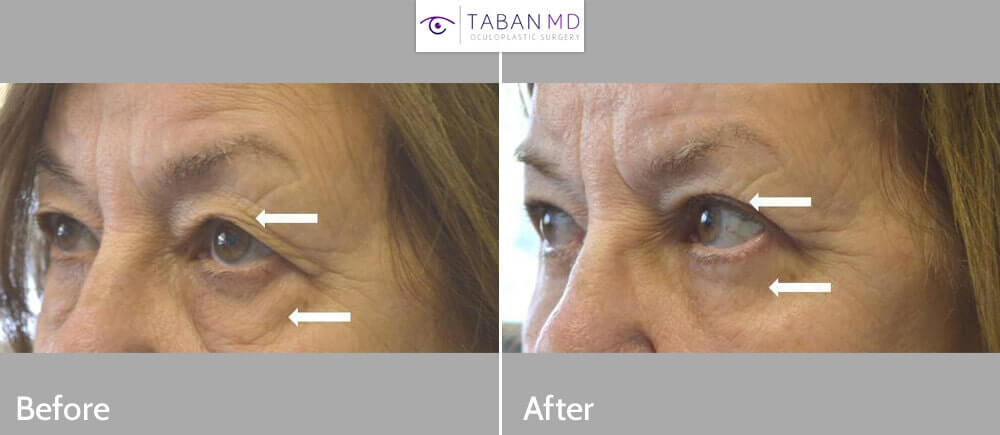 75+ year old woman, underwent cosmetic upper blepharoplasty (eyelid lift) and lower blepharoplasty to look more refreshed with natural results.
