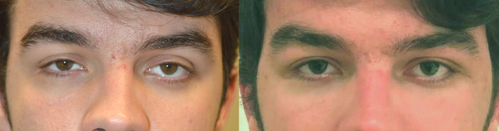 20 year old male, complained of uneven asymmetric eyes. This is due to sunken right eye from orbital blow out fracture and congenital left lower eyelid retraction. He already had right orbital fracture repair by another surgeon with persistent enophthalmos (sunken eye). He underwent left orbital decompression plus left lower eyelid retraction surgery. He also underwent droopy upper eyelid ptosis surgery on both eyes. Before and 6 weeks after eye plastic surgery photos are shown. Note improved eye symmetry and youthful eyes. droopy upper eyelid ptosis surgery eye asymmetry
