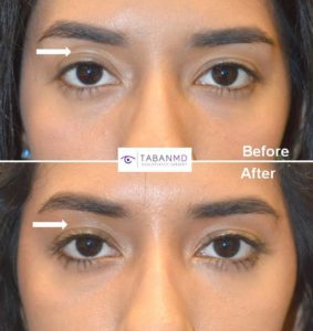 Young woman, complained of upper eyelid asymmetry with hollow sunken right upper eyelid with loose extra skin folds. She received right upper eyelid filler injection. Note improved eye symmetry. upper eyelid asymmetry beverly hills dr taban