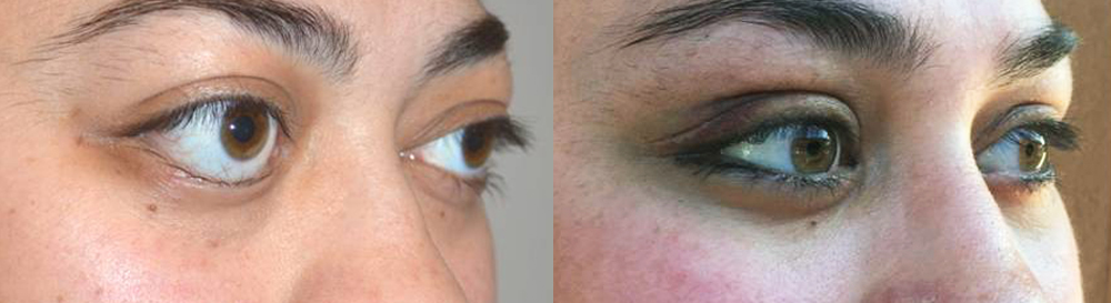 24 year old female before & after bulging eye surgery