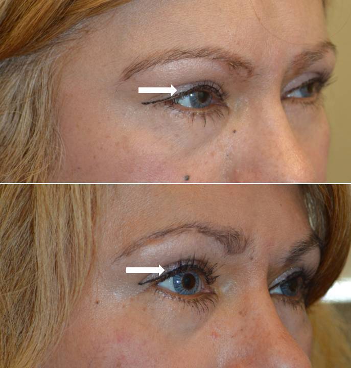 56 year old female before and after Eylelid Ptosis Surgery