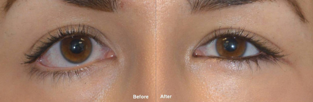 Eye Shape Surgery Beverly Hills